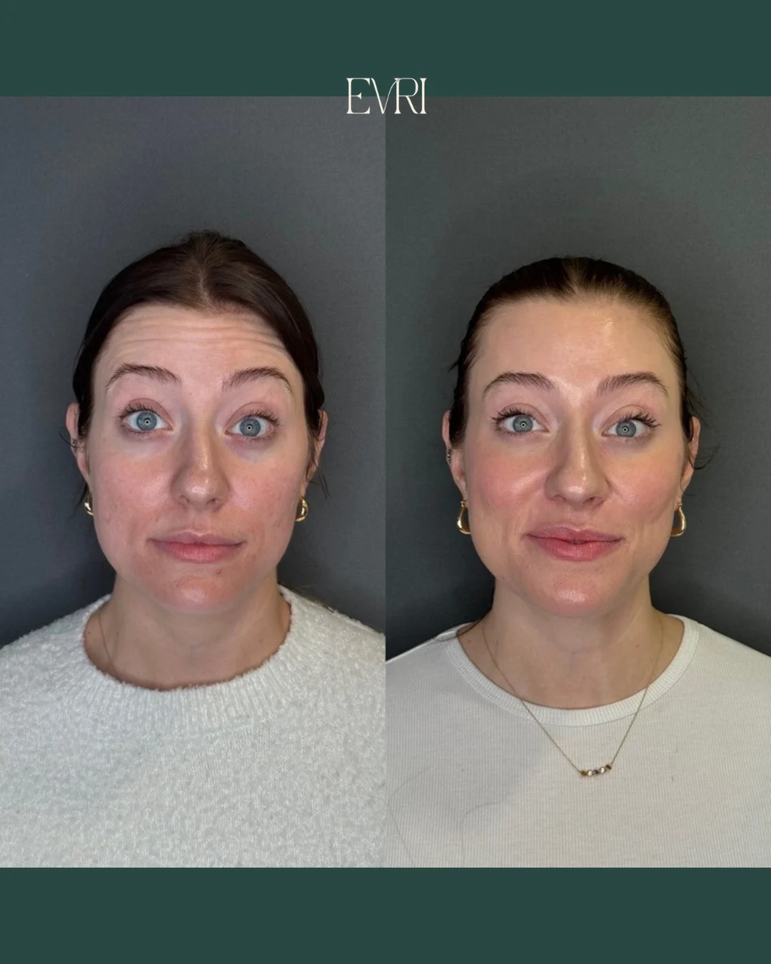 Insta Feed One in Wilmington, DE at Evri Aesthetics