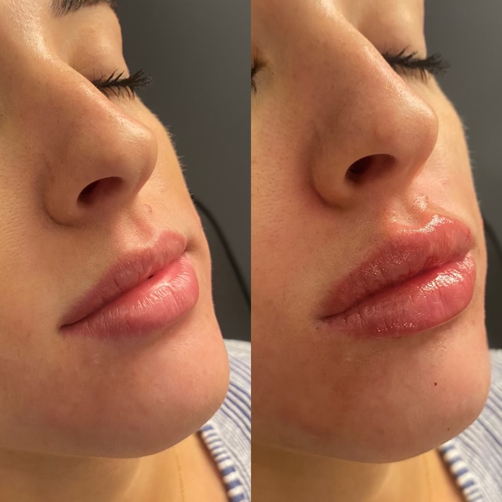 Dermal fillers for lips