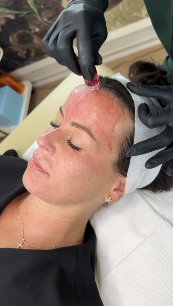 Applying the EVRI Secret Sauce Botox Facial