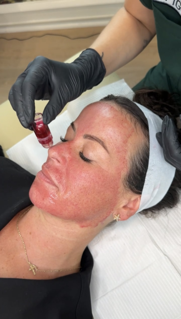 The Botox facial at EVRI