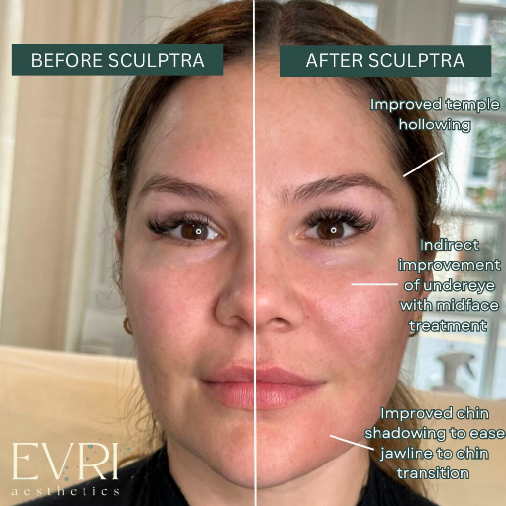 Sculptra injection at EVRI before and after